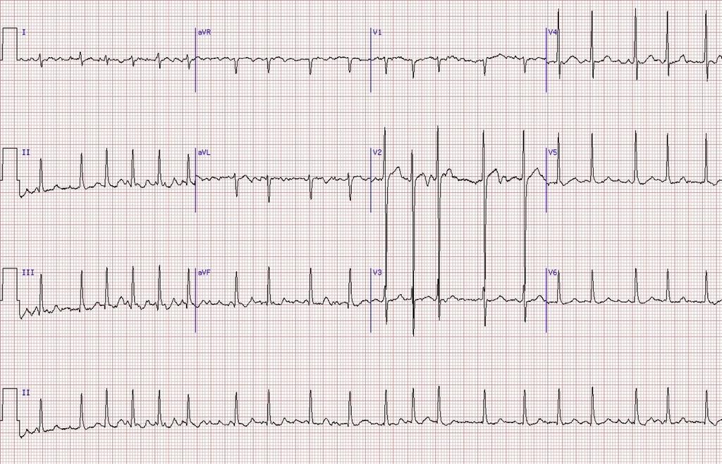 Case #2 ECG Rate: Count QRS complexes and multiply by 6. HR 120. Tachycardia. Rhythm: Any P-waves present? None, so A fib.