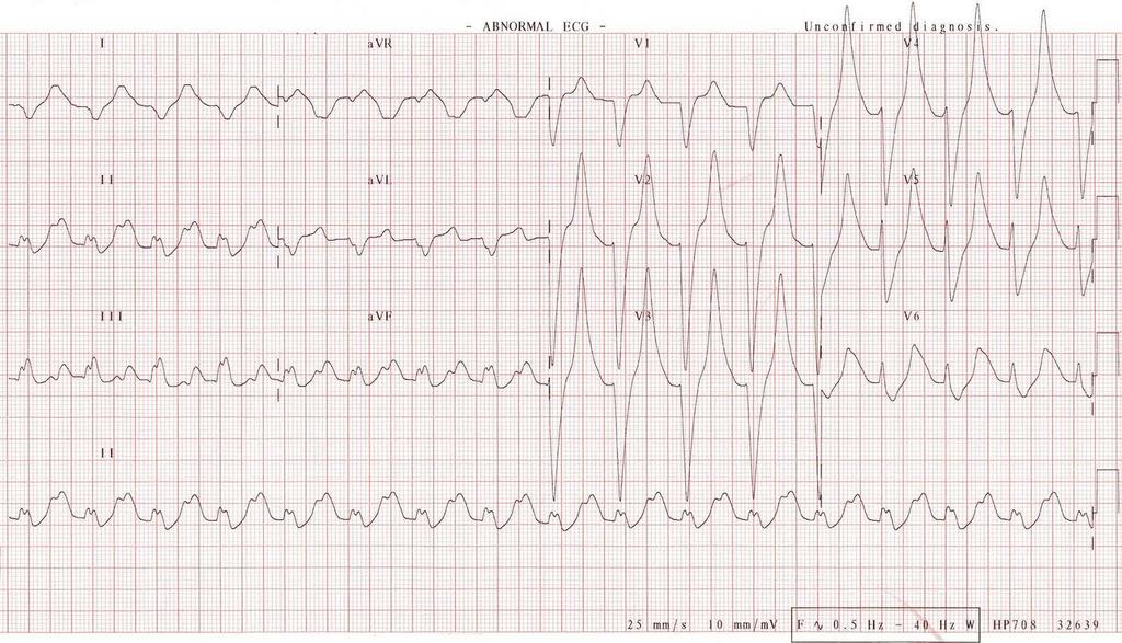 Case #5 ECG Rate: HR 120 Rhythm: Regular. Axis: Indeterminate Hypertrophy:? Intervals:? PR longer P waves: no? QRS complex: wide. ST segment T wave: Would they prick you finger? Yes.