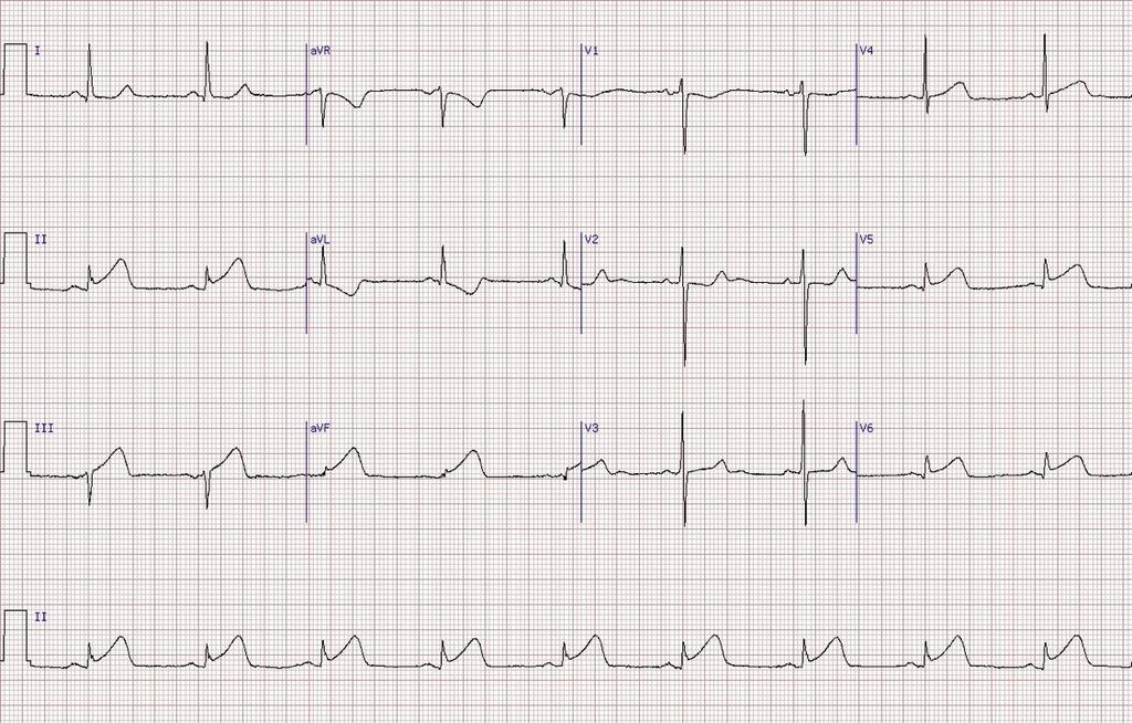 Case #6 ECG Rate: HR 55 Rhythm: Regular. Axis: Normal Hypertrophy: LVH Intervals: Normal QRS complex: Good R wave progression.