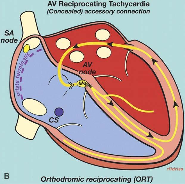 Orthodromic tachycardia Down the AV node, up the