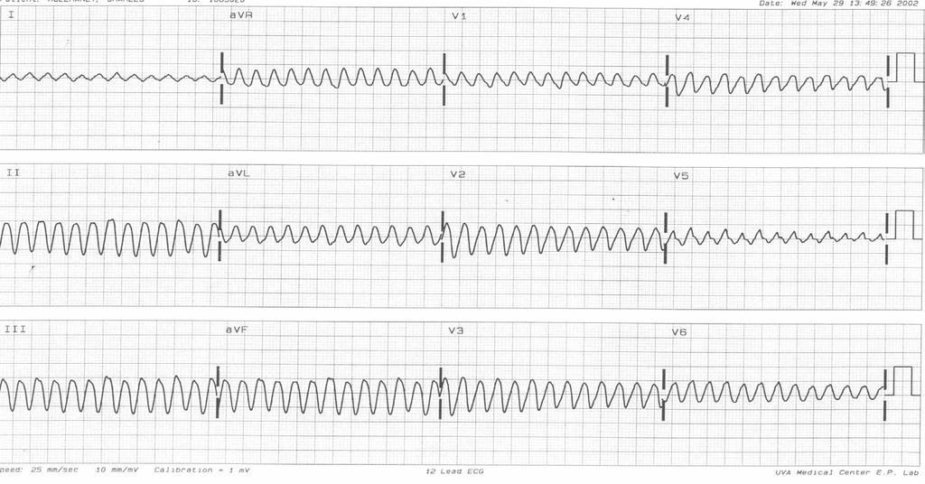 Wide Complex Tachycardias If unstable shock If stable and suspect SVT