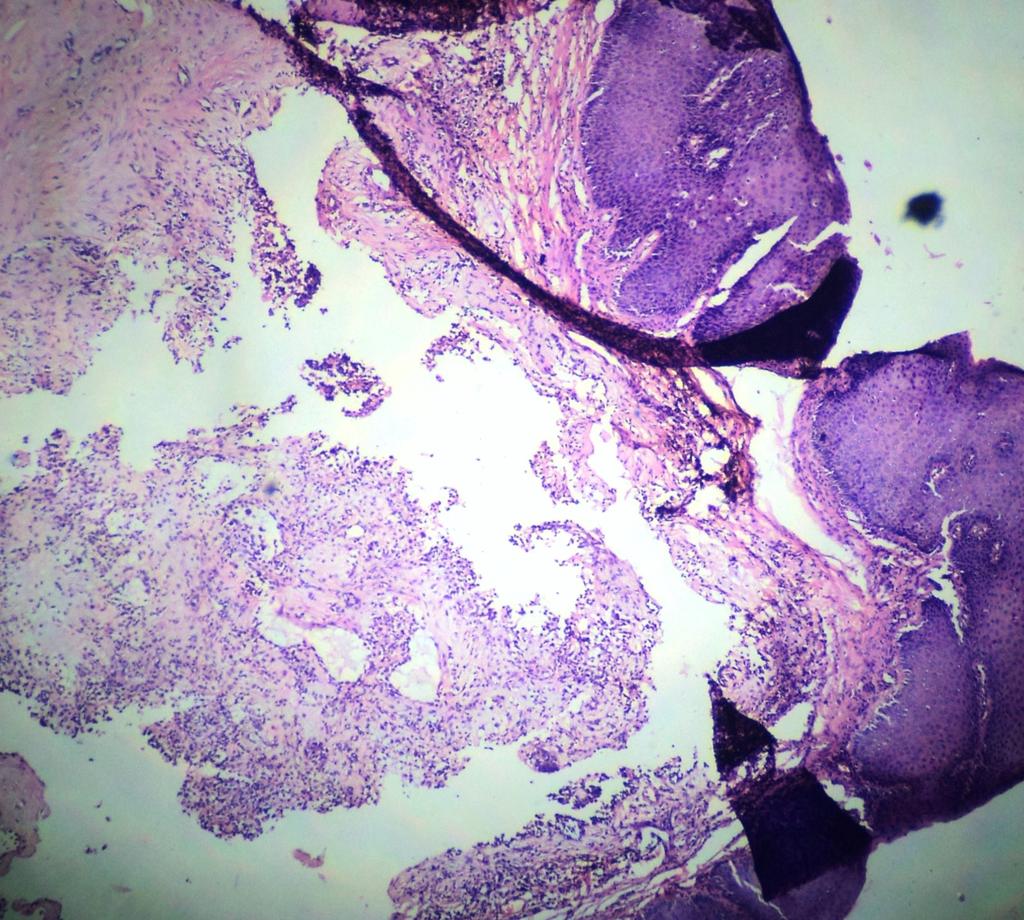Figure 4: Photomicrograph (Histopathology) showing tumor tissue beneath the stratified squamous epithelium