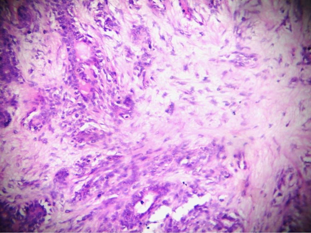 Figure 5: Photomicrograph (Histopathology) showing epithelial & stromal myxoid component (H&E stain 40X).