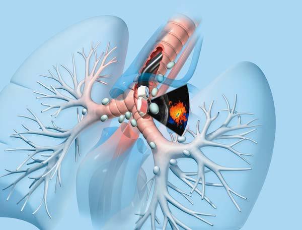 Utilizing EBUS (Endobronchial Ultrasound) for Diagnosis of Lung Cancer and