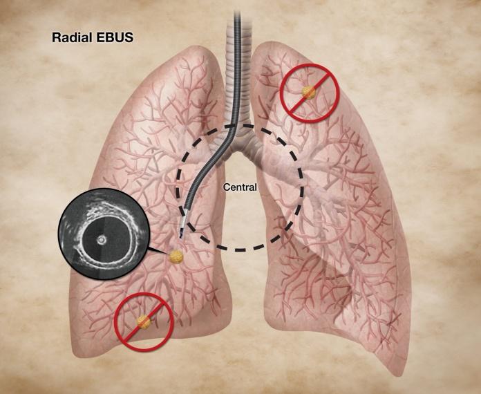 Radial probe EBUS (RP-EBUS) RP-EBUS provides high definition, 360-degree images of the airway wall and