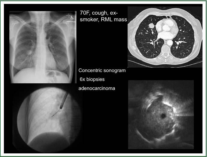 Example of RP-EBUS being used to diagnose a peripheral pulmonary lesion.
