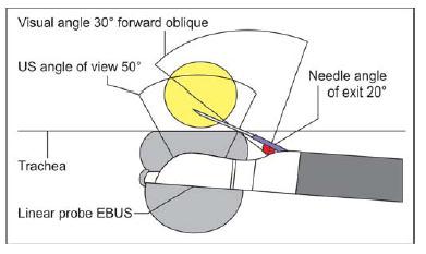 Convex probe EBUS (CP-EBUS) A