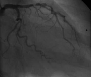 Cardiac Catheterisation High risk patient with chest pain Positive