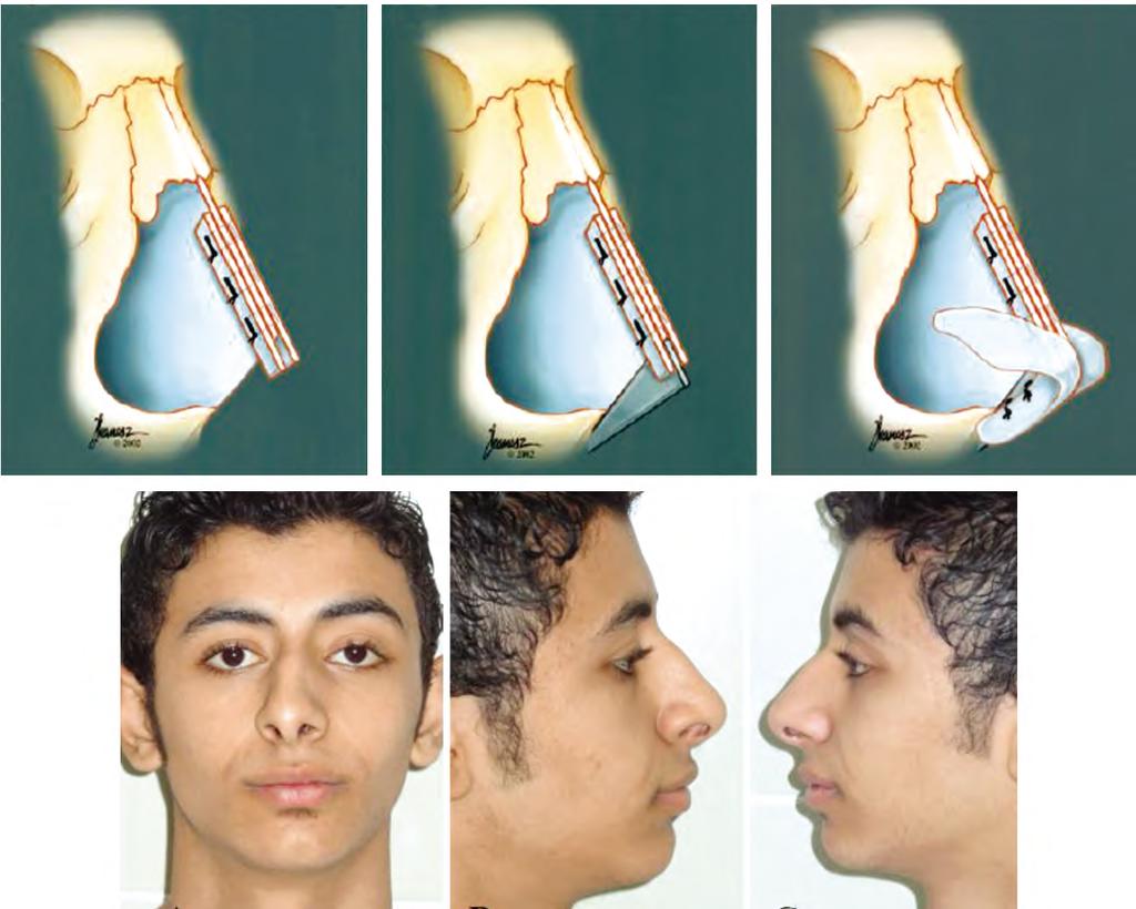 586 The Use of Spreader Grafts & Columellar Strut from the anterocaudal border of the nasal bones to the anterocaudal septal angle plus the planned nasal elongation.