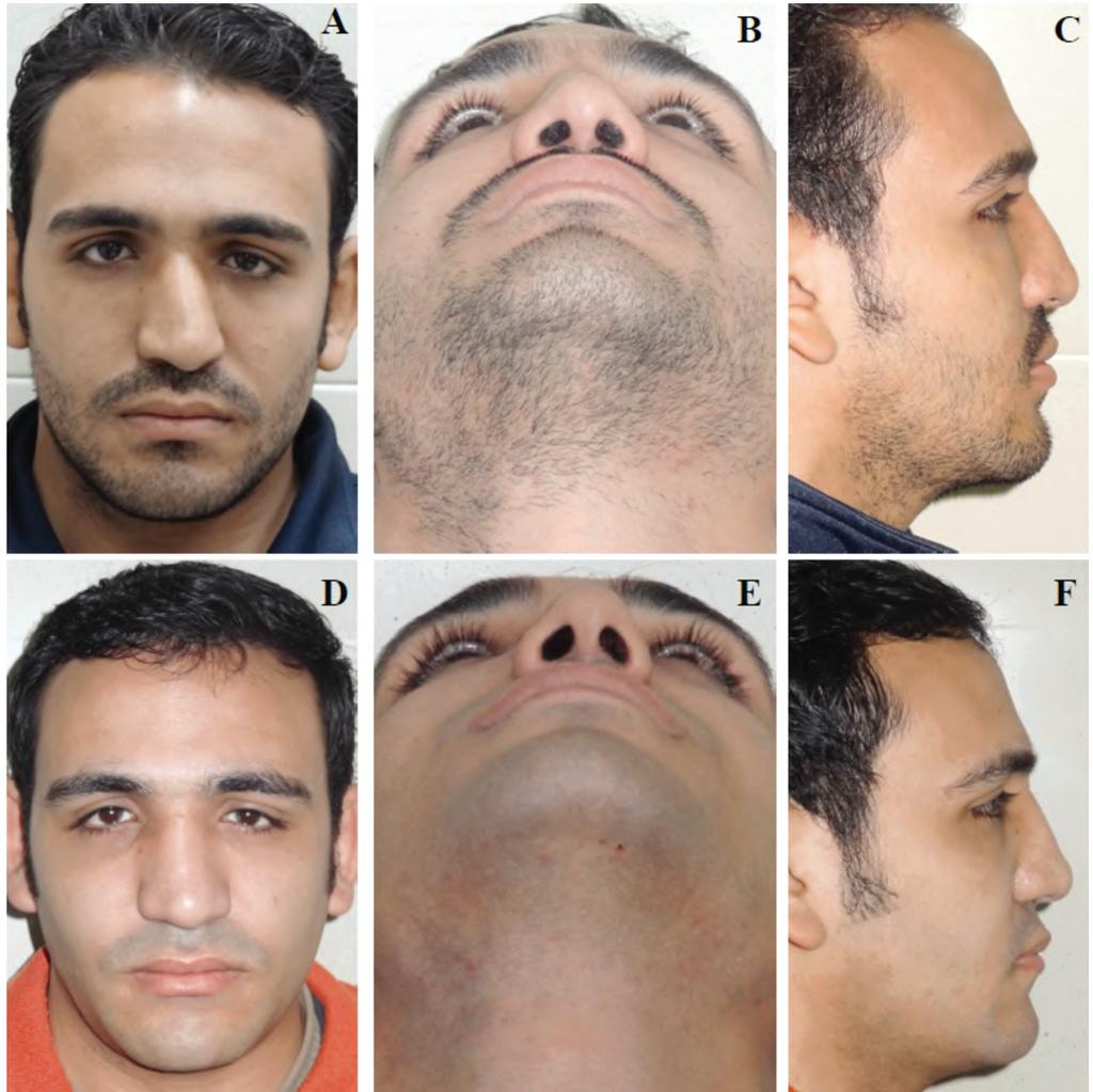 Usama A bd El-Naseer, et al. 587 Fig. (3): Male patient 26 years old with no history of trauma. (A,B,C) are the preoperative pictures. (D,E,F) are the postoperative pictures.