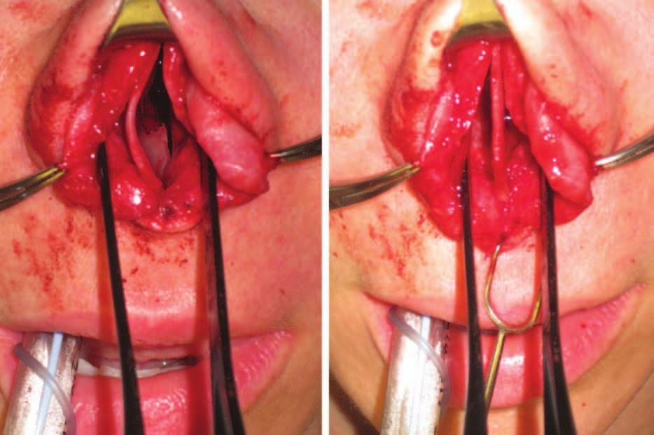 (Right) Repositioning of the caudal L-strut to the midline after excision of the excess caudal L-strut. Fig. 3.