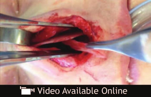 Plastic and Reconstructive Surgery September 2014 Video. Supplement Digital Content 1 addresses vertical excess of the L-strut followed by repositioning the caudal septum to the midline, http://links.