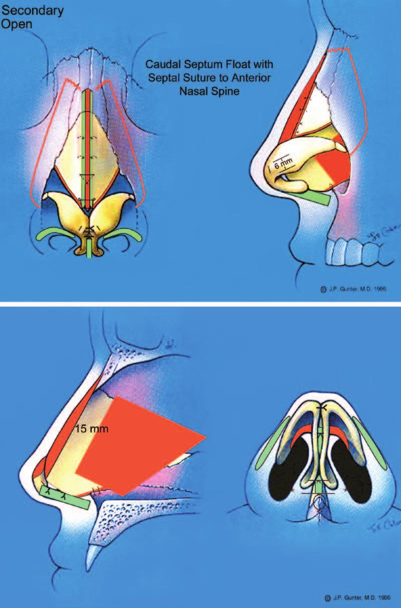 Plastic and Reconstructive Surgery September 2014 Fig. 7. Gunter diagrams for case 2.