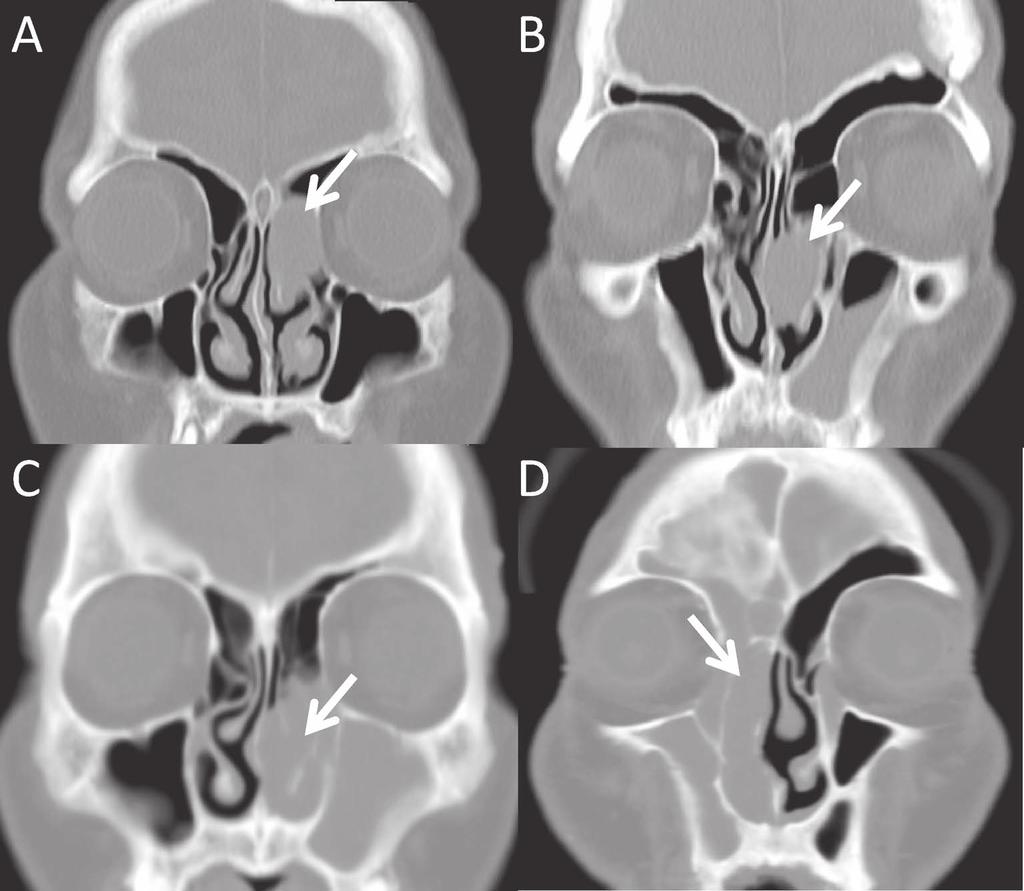316 K. Nomura et al. Fig. 1. Examples of tumor location and deviated septum. (A) Tumor localized in the left ethmoid. Nasal septum and the tumor are separated. An arrow indicates the tumor.