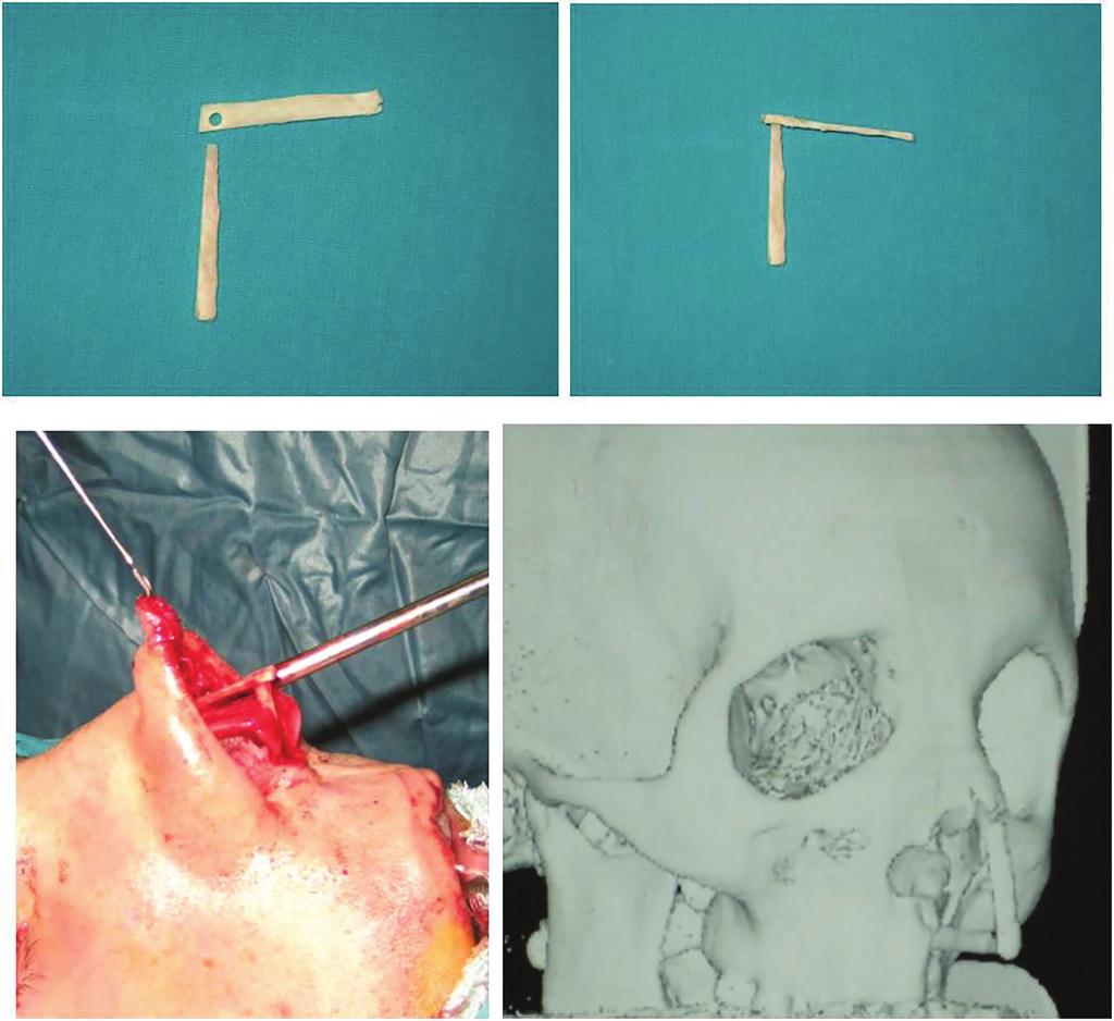 222 Nasal septal reconstruction Fig. 2: Two pieces of L-strut bone graft (above, left).