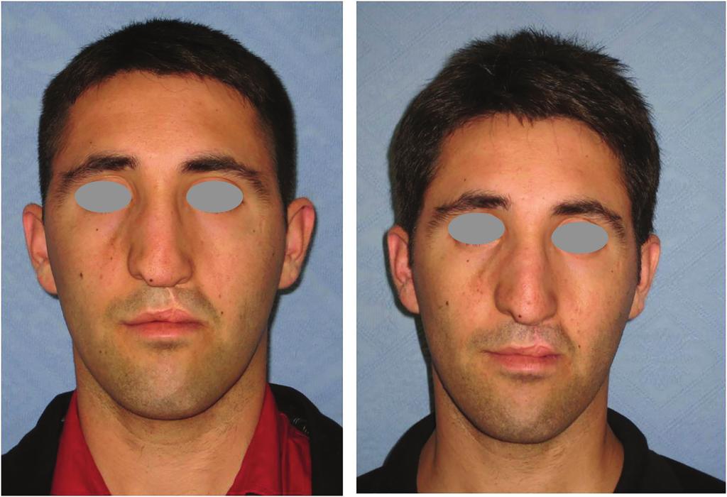 Cil 223 Fig. 3: Preoperative anterior view of the patient with nose deformity (left).