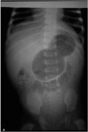 PYLORIC STENOSIS Signs & Symptoms Usually presents 2 weeks to 2 months after birth Most commonly presents as non-bilious vomiting, which may become projectile Patients may have a voracious appetite