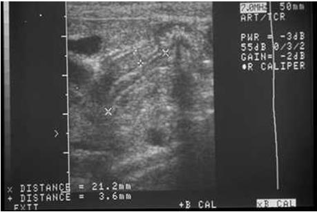 PYLORIC STENOSIS Diagnosis UGI-string sign, mushroom sign, shoulder sign Ultrasound Pyloric wall thickness > 4mm ( normal <2mm) Canal length is >14mm ( normal <10mm) PYLORIC STENOSIS Diagnosis