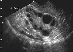 Polycystic Ovarian Syndrome Adipose Tissue Muscle PCOS: Epidemiology 4.7-6.8% of women have PCOS as defined by the NIH criteria (Knockenhauer et al.