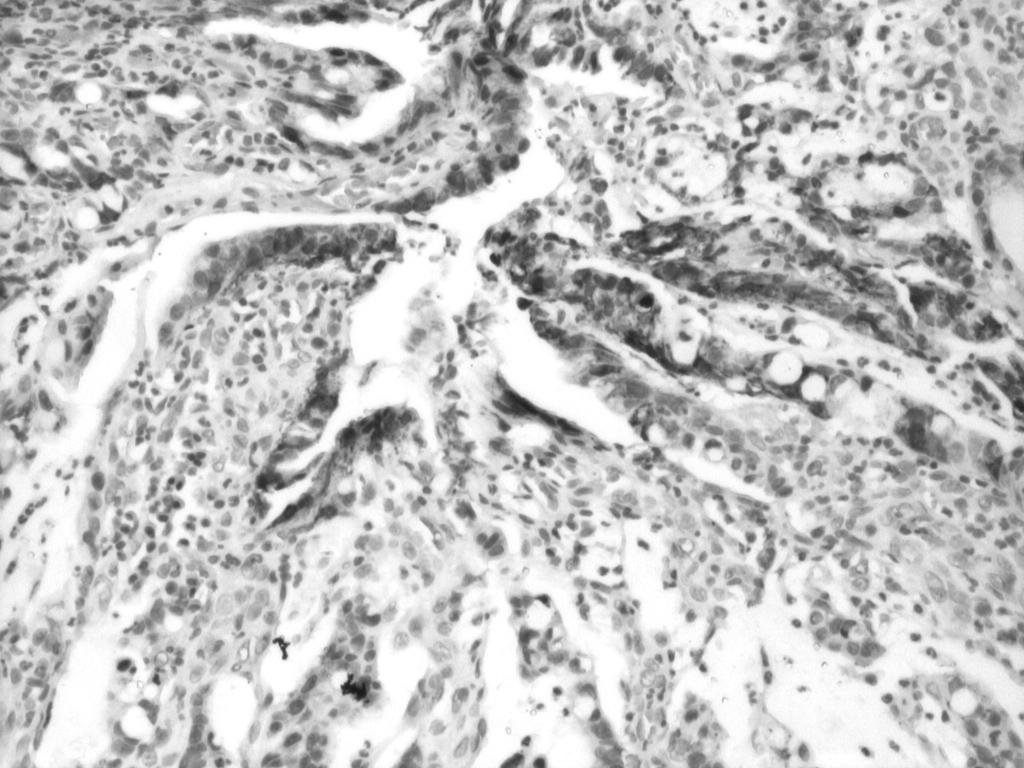 Figure 4. Positive MUC1 immunostaining in weak differentiated adenocarcinoma G3. Cytoplasmic and membranar brown immunostaining that localize the antigen.