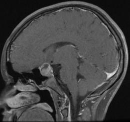 Expansile pituitary mass CT: may have cysts, necrosis, hemorrhage MRI: isointense to gray matter with homogeneous