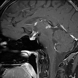 Ca++ and hemorrhage rare MRI: DWI hyperintense, marked +C 5-10% have additional lesion in pineal region CSF spread