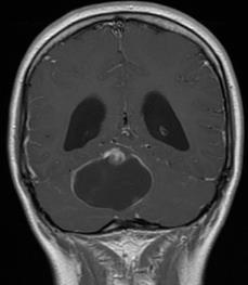 Case 1 Case 1 7 year old female with progressive ataxia Sagittal T2WI Axial DWI Axial T1WI+C Case 1: Differential Diagnosis