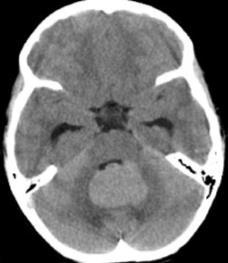 cerebellar hemisphere CT: 20% Ca++ MRI: cyst does not FLAIR suppress, DWI negative, solid component +C Coronal T1WI+C Case 1: