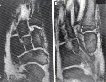 Imaging Magnetic Resonance Imaging: Clear diastasis on WB AP image do not MRI Equivocal or nl