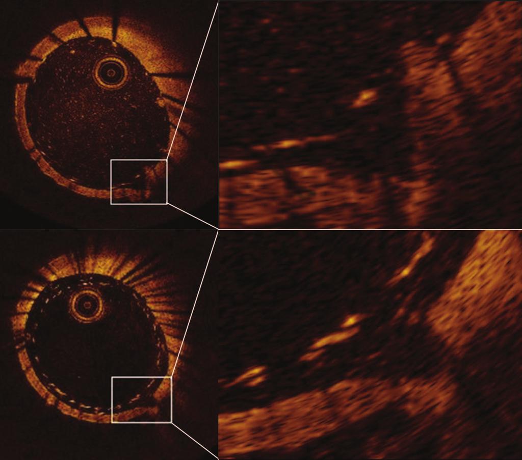 Figure 3 Photographs showing optical coherence tomography (OCT) images after deployment of the new Low-profile Visualized Intraluminal Support device (LVIS Blue) (top) and the Flow Redirection