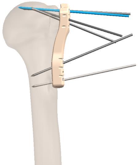 Bicipital Groove (center of jig frame aligned just lateral to insertion of pectoralis major).