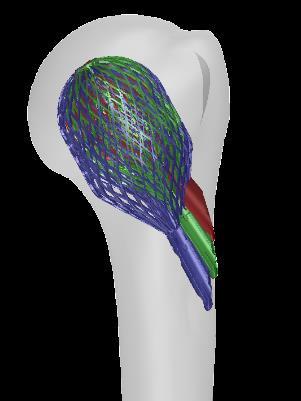 specific fixation - Designed for secure fixation in all bone,