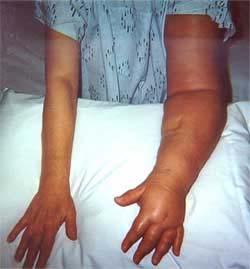 Lymphedema Defined Lymphedema is an accumulation of protein-rich rich lymph fluid in the interstitial spaces of an affected body part, most frequently in