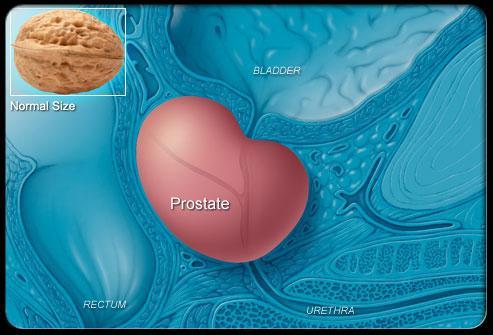 The second condition is termed prostatitis (inflammation or infection of the prostate gland). Both conditions are treated medically but some individuals with BPH may require surgical treatment.
