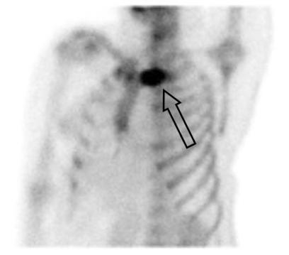 On T2 weighted image, mild high signal intensities on the marrows of her left clavicle and manubrium (hollow