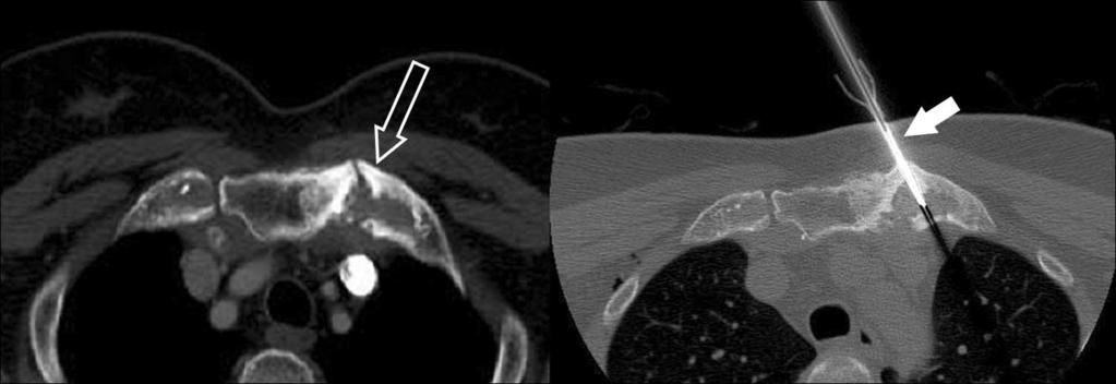 bottom image). c. Bone scintigraphy shows hot uptake at left costosternoclavicular region (hollow arrow). d.