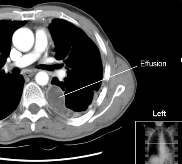 Obstructive Pneumonitis Combination of atelectasis, bronchiectasis with mucous plugging, and parenchymal inflammation that develops distal to an obstructing endobronchial lesion.