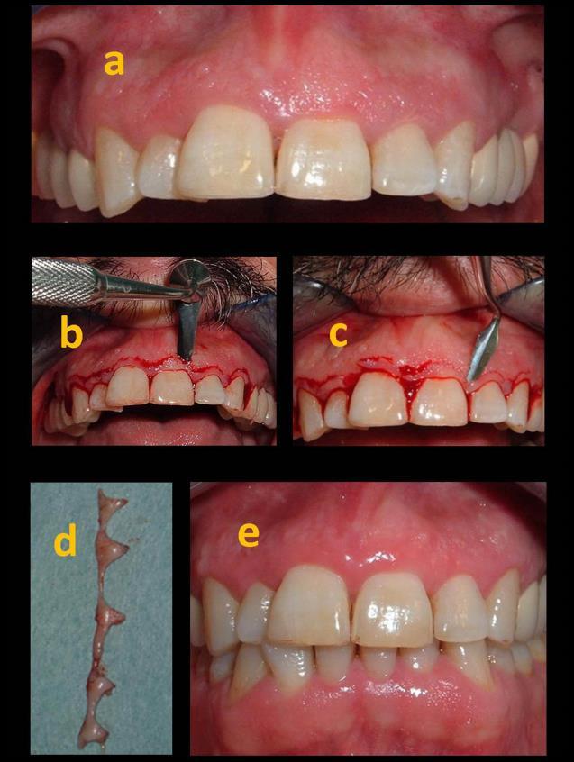 51 Esthetic crown lengthening Assaf M Attrition of the incisal edges of teeth needs to be compensated when estimating the cementoenamel junction of the worn teeth.