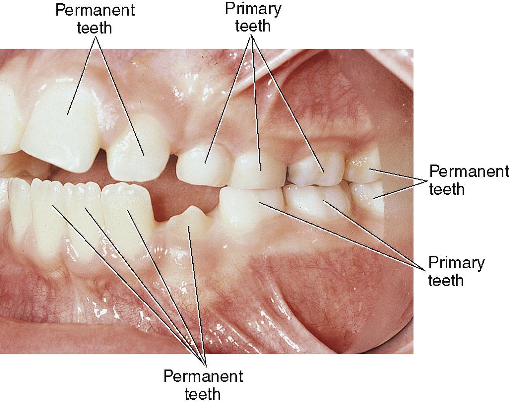 It is common to see extensive wear on incisal edges and occlusal of