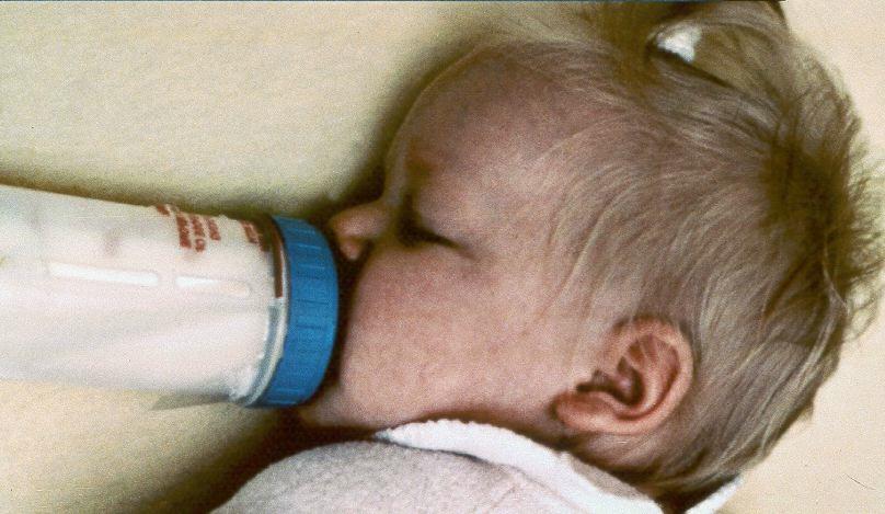 Clinical Consideration for Primary Dentition Prolonged nighttime use of a baby bottle with cavity-causing beverage
