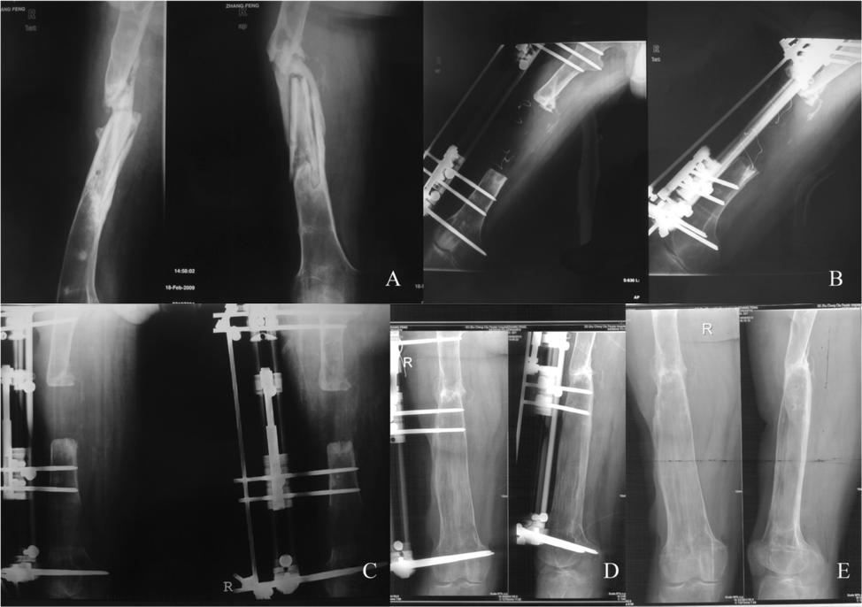 Yin et al. Journal of Orthopaedic Surgery and Research (2015) 10:49 Page 4 of 9 Figure 2 A 33-year-old man who had an infected femur nonunion.
