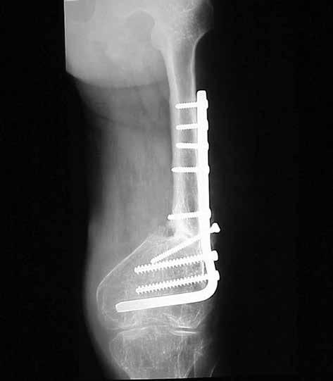 Post-operative Anterior-Posterior Radiograph Showing Approximation of Bone Ends, Condylar Plate Fixation and Iliac Bone Grafting vere osteoporosis of the leg bones, tibial osteotomy was performed in