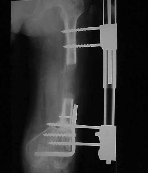 Surgical Treatment for Femoral Non-Union Said GZ et al. Figure 5. The FemurDuring Lengthening Using a Unilateral Frame.