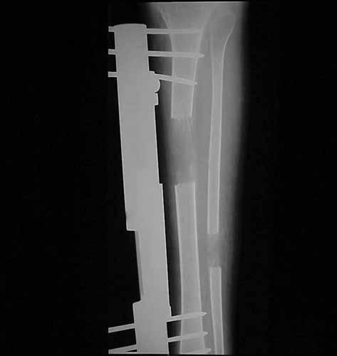Simultaneous Lengthening of the Leg Bones Using a Unilateral Frame Figure 7.
