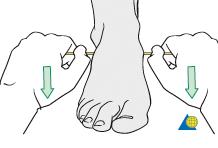 The choice depends on personal preference and experience. The following reduction techniques are often well suited for intramedullary fixation of distal tibia fractures.