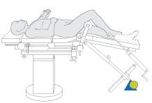 REDUCTION AND MEDULLARY CANAL PREPARATION TRACTION TABLE The patient is positioned supine on the fracture table. The contralateral uninjured leg is placed on a leg holder.
