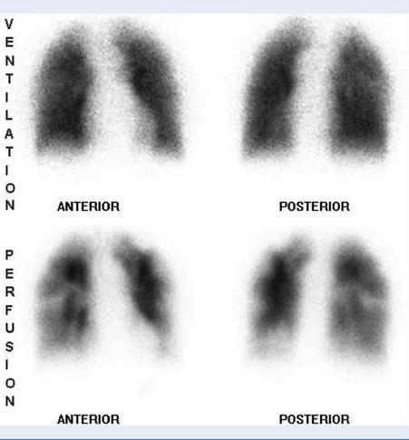 Lung Ventilation and Perfusion (VQ) Scan Ventilation : air intake Perfusion : blood flow Tests
