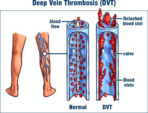 VTE Patho-physiology Dislodgement of blood clot Lower Extremities (65%-90%) Pelvic venous system