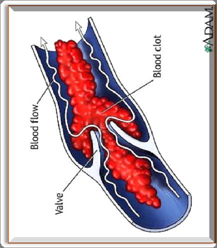 VTE Patho-physiology http://www.nursinglink.