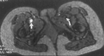 MRI for DVT No flow effect in Spin-echo Gradient-recalled echo Filling defect